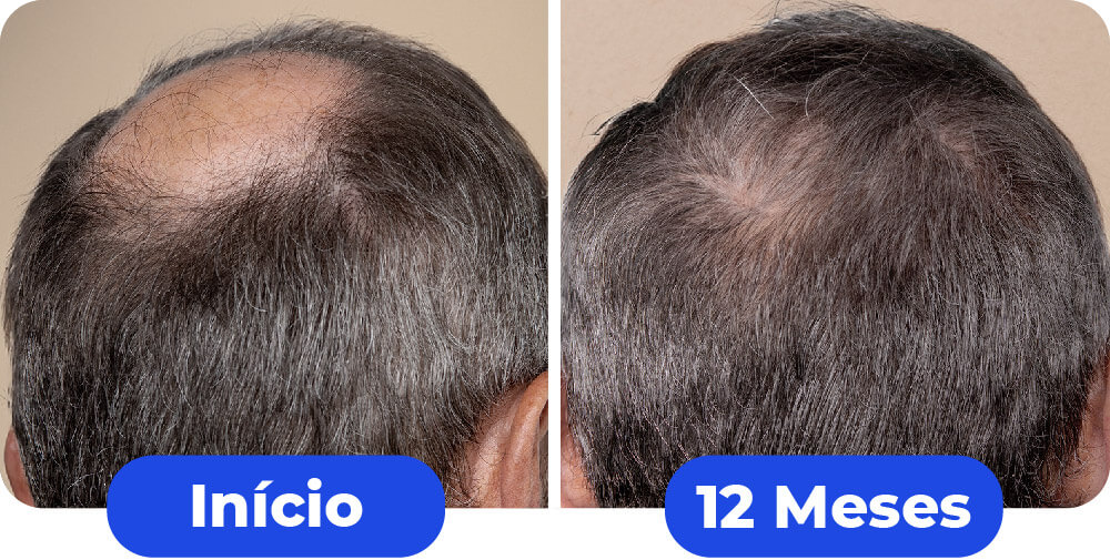 1comparativo-maxxhair-07