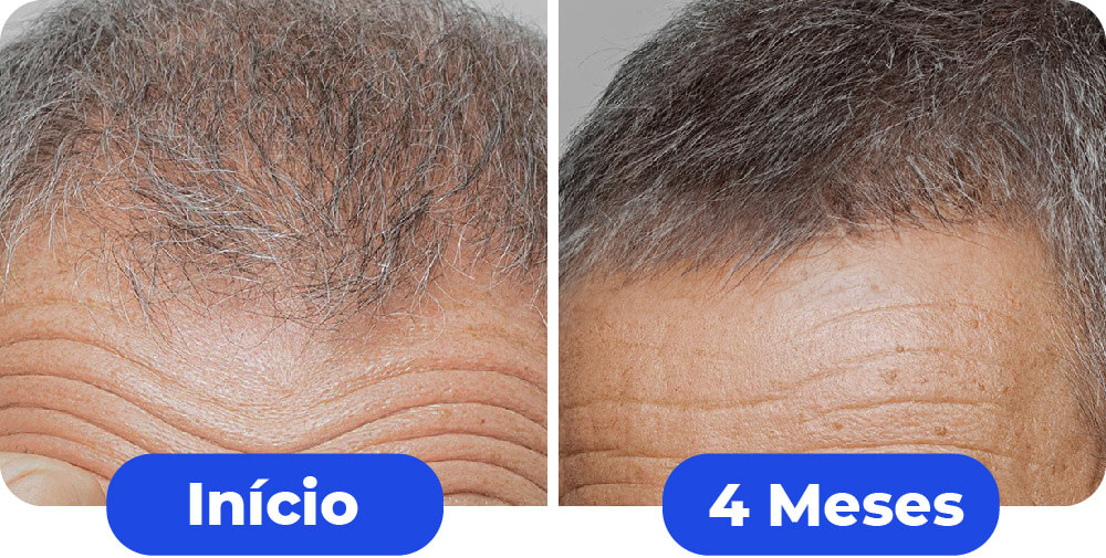 1comparativo-maxxhair-09
