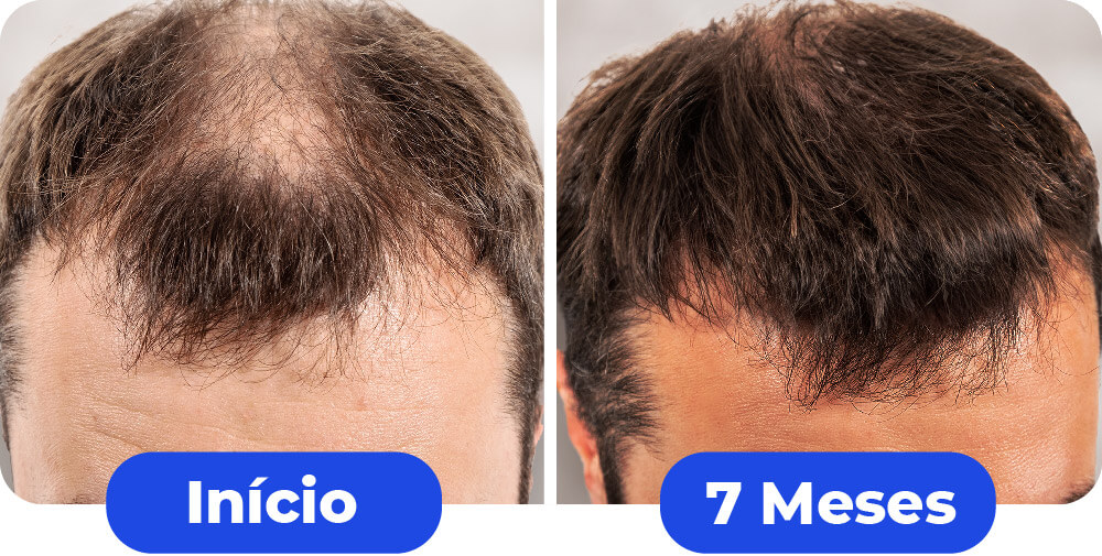1comparativo-maxxhair-10